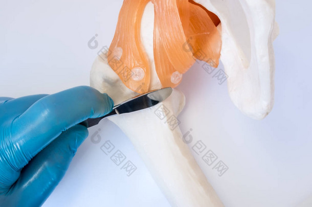 骨科或外伤外科概念照片。外科医生手持外科手术刀, 穿着手套, 在髋关节附近的股骨骨上, 象征着骨关节骨科手术