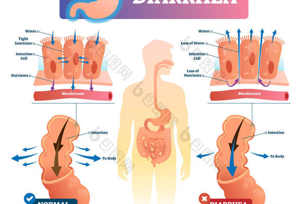 腹泻媒介例证。有标签的胃肠道疾病医疗方案.