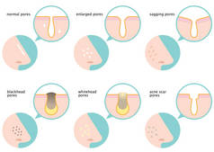 鼻部皮肤毛孔集: 正常、下垂、肿大、黑头、白石、痤疮疤痕