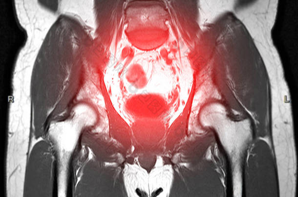 下腹冠状平面T2技术检测子宫肌瘤.