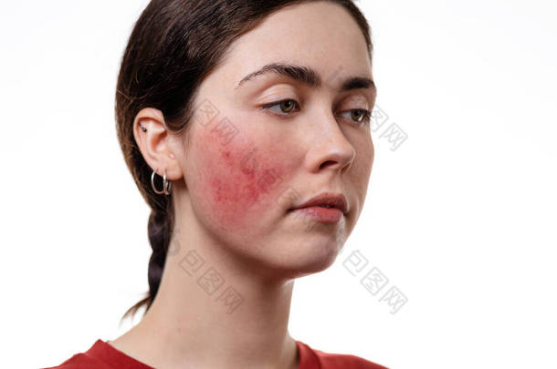 一个年轻的高加索女人在特写中的肖像，在她的脸颊上显示出了迷迭香。白色背景。红葡萄酒和脸上的炎症.