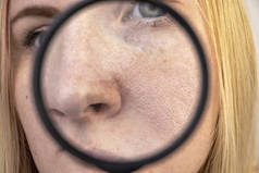 毛孔扩张，黑斑，痤疮，鼻腔闭锁。 一位妇女正在接受医生的检查。 皮肤科医生用放大镜，放大镜检查皮肤