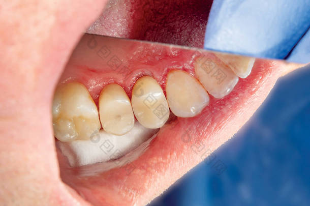 两个咀嚼侧牙的上颌骨治疗<strong>龋齿</strong>后。用橡胶坝系统感光树脂充填材料修复咀嚼面