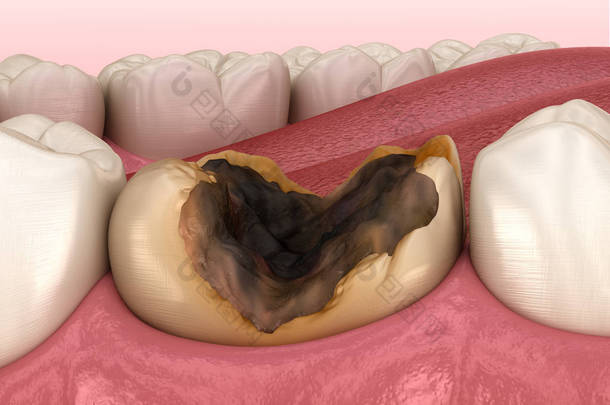蛀牙被龋坏了.医学上准确的牙齿3D图像.
