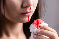 鼻出血，一名年轻女子鼻子出血，用纸巾止血。医疗保健与医疗理念.