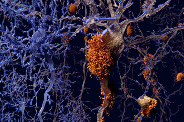 阿尔茨海默病, 神经元网络与淀粉样斑块。插图