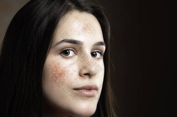 在她二十几岁出头的时候，一位焦虑的年轻<strong>白种人</strong>有着问题的皮肤、痤疮和红肿的近照在她的额头上，脸颊上有扩张的肤浅血管.