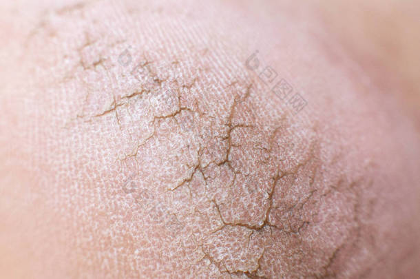 人的脚后跟干裂的皮肤，特写。 严重皮肤病和真菌感染的概念、宏观代谢过程