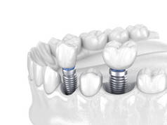 前磨牙和磨牙冠安装在植入物-白色概念之上.人类牙齿及假牙的3D图解