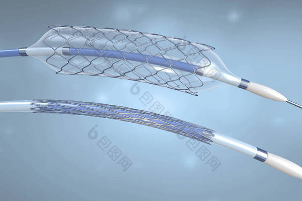 支架和导管植入血管与空和填充气球-3d 例证