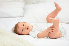 孩子的红疹躺在床上, 婴儿过敏的概念