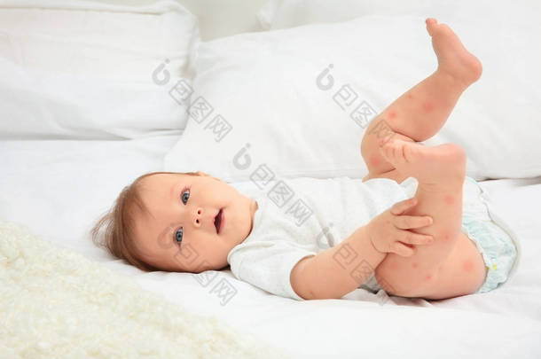 孩子的红疹躺在床上, 婴儿<strong>过敏</strong>的概念