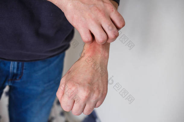 衣衫褴褛的男人用手挠痒痒。手上拿着银屑病或湿疹有红斑的异位过敏皮肤