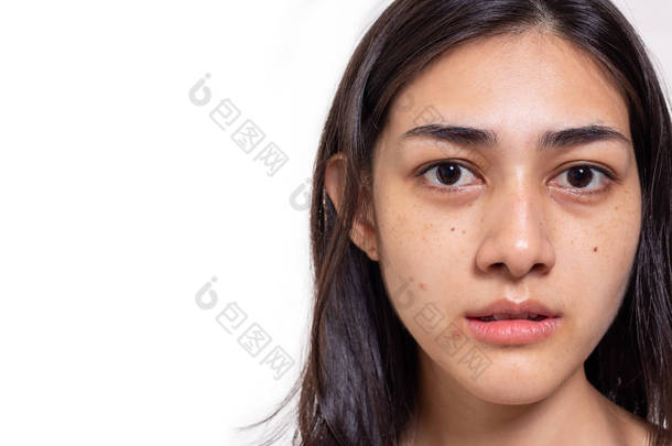 亚洲女人脸上有雀斑、瑕疵、粉刺和皮肤迟钝。 迷人的美丽的亚洲女人有一双黑眼圈，她脸上没有化妆品。 她看起来很不高兴 隔离在白色、复制空间上