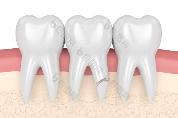 牙根开裂的牙龈在白底上的3D呈现。不同类型的断牙概念.