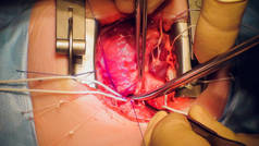 做心脏手术心脏移植手术的医生