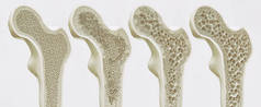 骨质疏松症4个阶段--3d 渲染