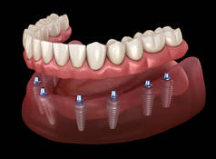 下颌假肢 所有8个系统支持植入物。人类牙齿和假牙概念的医学上精确的三维插图