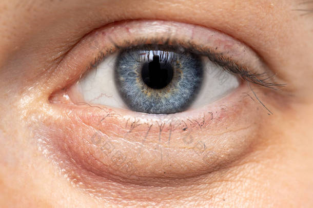 一个有着蓝色虹膜的年轻<strong>白种人</strong>女士眼中的宏观景象。眼球下方可见眼袋肿胀（眼眶周围肿胀） 。一种不健康和忙碌的生活方式的共同症状.