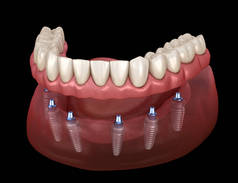 下颌骨假体全部安装在6个由植入物支撑的系统上。医学上准确的人类牙齿和假牙概念三维图像
