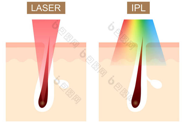 激光和IPL (强<strong>脉冲</strong>光)脱毛差异.护肤概念