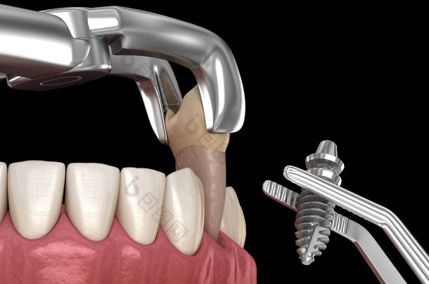 取出和植入，复杂的直接手术。牙科治疗的医学上准确的3D图像