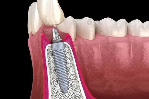 标准基托,假牙植入物和<strong>陶瓷</strong>冠.医学上准确的牙齿3D图像.