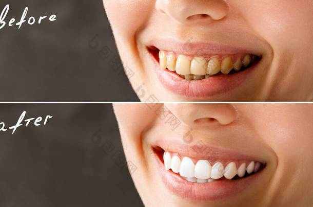 美白前后的妇女牙齿。白色的背景。牙科诊所的病人图为口腔护理、牙科、口腔科的象征.