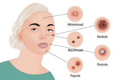 痤疮类型脸向量插图美容护肤品皮肤治疗