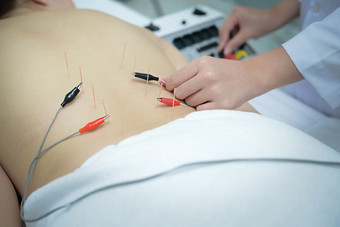 电中国人针灸和电针刺激身体病人
