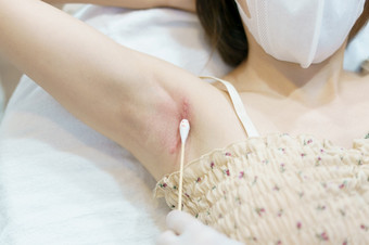 特写镜头医生护士清洁伤口与棉花后注射治疗为keloids的腋窝keloids从乳房手术