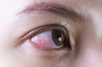 红色的充血眼睛女人恼怒的受感染的结膜炎眼睛后哭