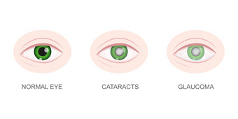健康的白内障和青光眼眼睛特写镜头视图眼球与正常的和不健康的镜头老化视觉问题概念在解剖学上<strong>详细</strong>的人类器官愿景向量卡通插图健康的白内障和青光眼眼睛特写镜头视图眼球与正常的和不健康的镜头老化视觉问题概念在解