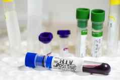 艾滋病毒艾滋病感染血测试样本诊断实验室化学液体元素