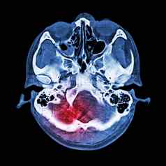 大脑受伤中风扫描大脑基地头骨骨窗口