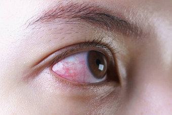 红色的充血<strong>眼睛</strong>女人恼怒的受感染的结膜炎