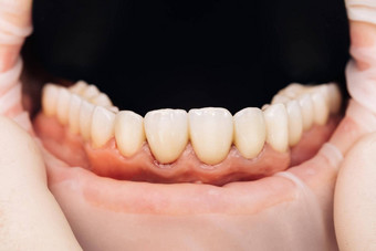 陶瓷冠人类牙齿特写镜头宏概念审美牙科氧化锆桥瓷美丽的女牙齿宏贴面板