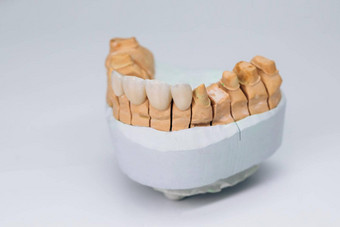 牙科锆石陶瓷冠模型下巴金属免费的陶瓷牙科冠牙科贴面板石膏模型