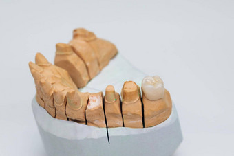 金属免费的<strong>陶瓷</strong>牙科牙齿<strong>陶瓷</strong>贴面板孤立的wite背景金属<strong>陶瓷</strong>冠石膏模型牙科实验室