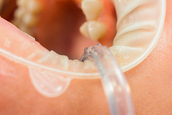牙医<strong>抛光</strong>牙齿钻牙科过程牵开器隔离嘴唇牙龈