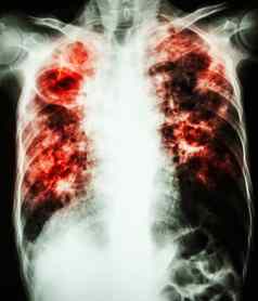 分枝杆菌肺结核感染肺肺结核
