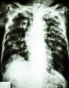 肺肺结核