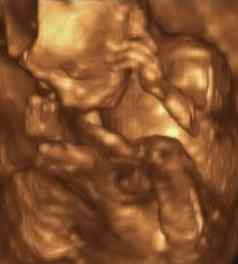 超声波回波描记术月胎儿意大利