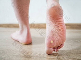 关闭照片足底等男人的脚赘肉plantaris非常