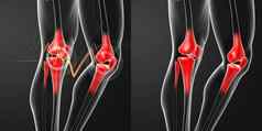 呈现人类膝盖疼痛解剖学骨架腿
