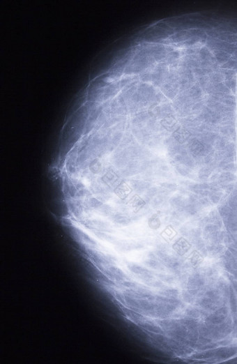 x光乳房肿瘤