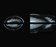 乳房x光检查x光电影图像乳房癌症