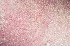 肝肝硬化病组织显微镜