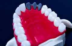 牙植入物皇冠安装过程