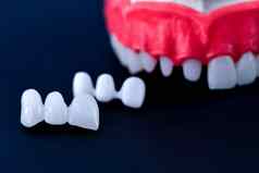 牙植入物皇冠安装过程